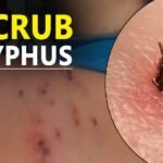 Scrub Typhus