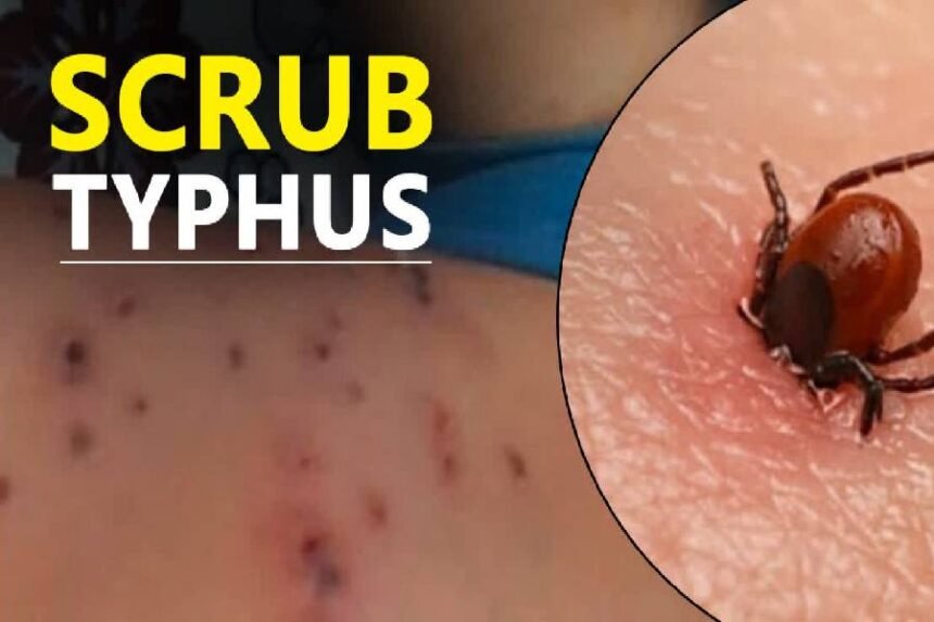 Scrub Typhus